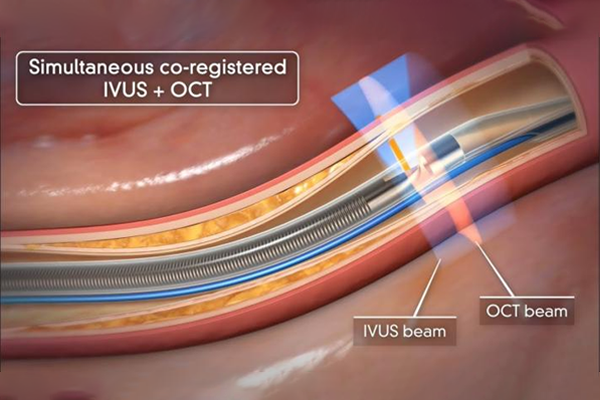 intravascular imaging IVUS