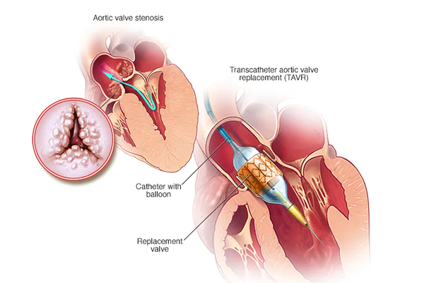 Non Surgical Valve Replacement (TAVI)