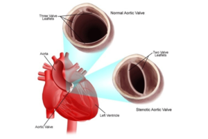 Pediatric Heart Disease | stenotic aortic valve