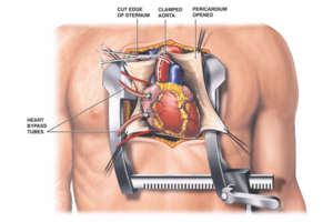 open heart valve replacement