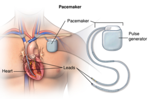 pacemakers and Devices | pulse generator