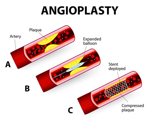 angioplasty balloon vs stent