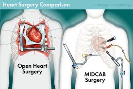 Difference Between Bypass and Open Heart Surgery