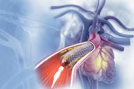 Difference Between Bypass and Open Heart Surgery