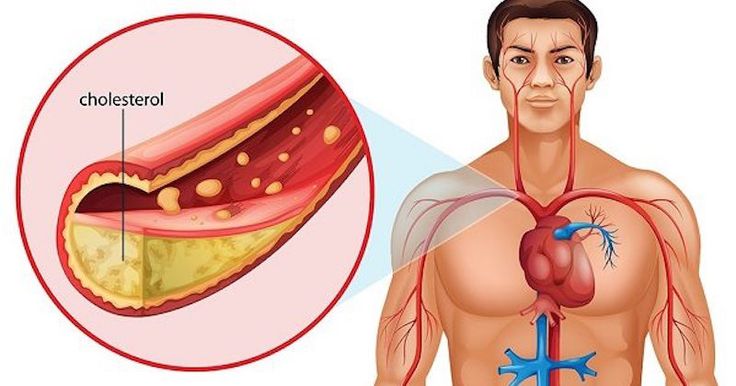 Why Cholesterol Matters for Heart Health: